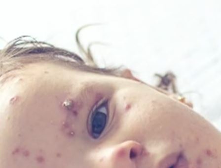 As the epidemic continues, measles eradication is on the verge of danger in the Americas As the epidemic continues, measles eradication is on the verge