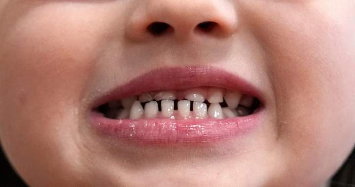FDA restricts use of children's fluoride supplements due to new health risks – National Fda restricts use of children's fluoride supplements due to new