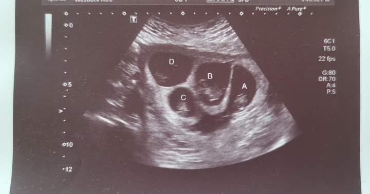 Alberta mother prepares to welcome 'miraculous' quadruplets Alberta mother prepares to welcome 'miraculous' quadruplets